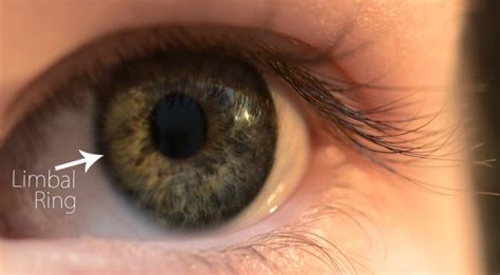 Can limbal rings get darker?