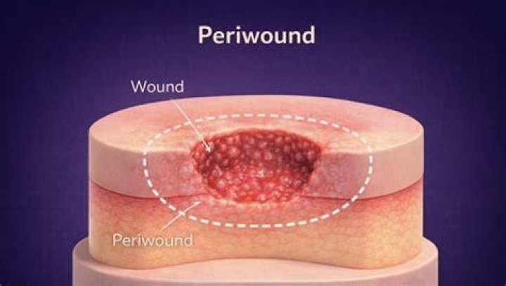 How To Care For Peri Periwound Wound? (Best solution)
