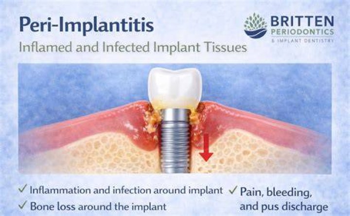 How To Fix Peri Implantitis At Home? (Solved)