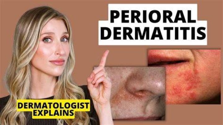 How To Heal Peri Oral Dermatitis Quickly?