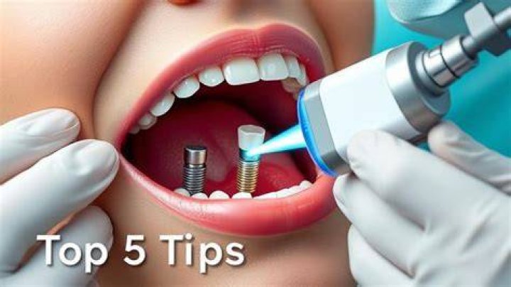 How To Prevent Peri Implantitis? (TOP 5 Tips)