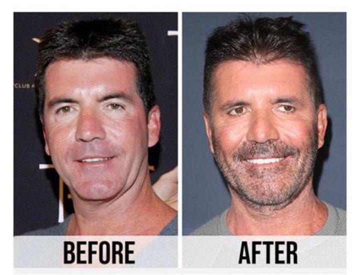 Simon Cowell talks face fillers, says he went too far