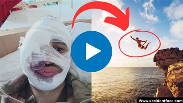split face diving accident diving face split face split diving accident
