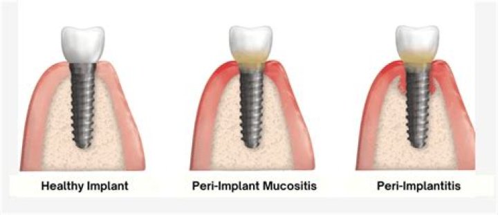 What Causes Peri-implantitis? (Solved)