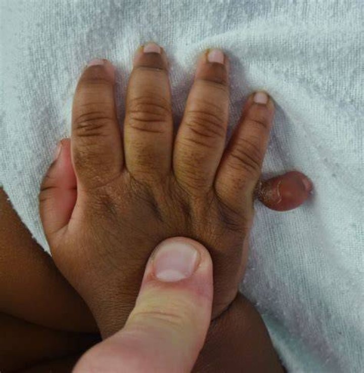 What condition gives you extra fingers?