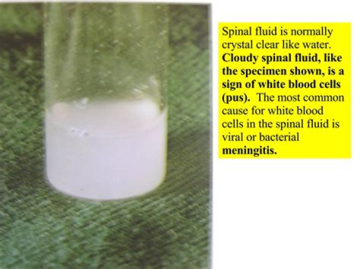 What does it mean when spinal fluid is cloudy?