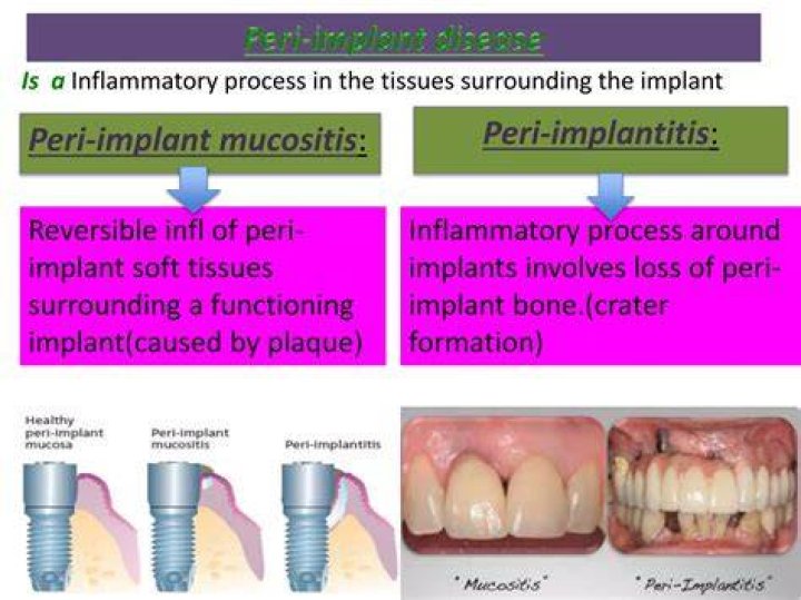 What Is A Peri Implant Defect? (Solution)
