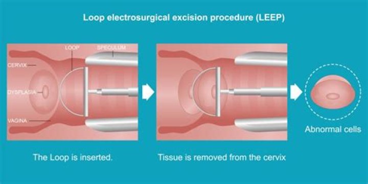 What is a top hat LEEP procedure?