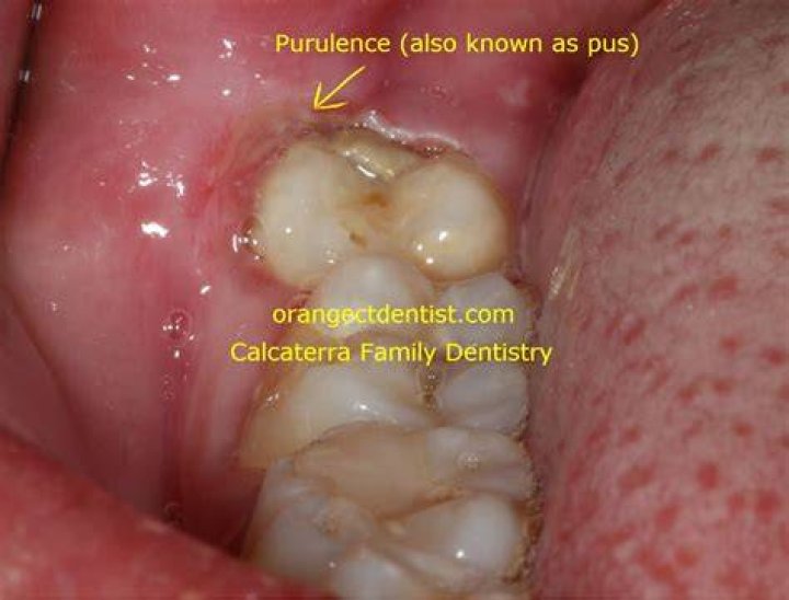 What Is Inflammation Around A 3rd Molar Peri Something?