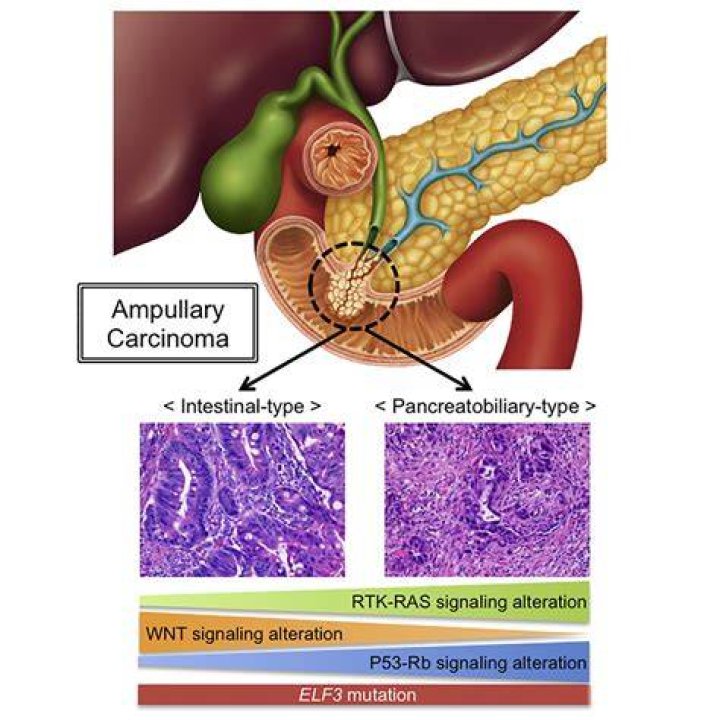 What Is Peri Ampullary Cancer? (Correct answer)