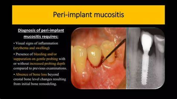 What Is Peri Implant Mucositis? (Question)