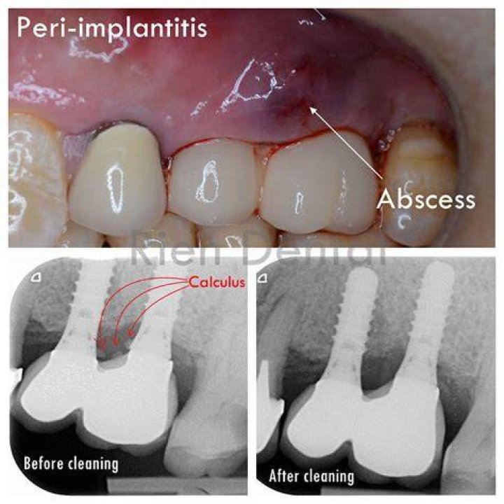 What Is Peri-implantitis? (Solution)