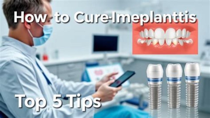 What Is Peri Implantitis? (TOP 5 Tips)